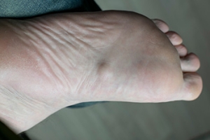 What a Plantar Fibroma Is and How a Podiatrist Can Help
