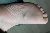 What a Plantar Fibroma Is and How a Podiatrist Can Help