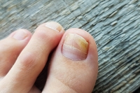 Symptoms and Risk Factors for Toenail Fungus