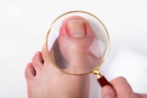 When Ingrown Toenails Become Infected
