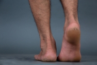 Cracked Heels and Help From a Podiatrist