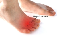 Morton’s Neuroma Facts