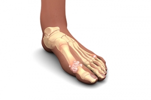 What Can Cause Gout?