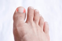The Symptoms of an Ingrown Toenail