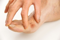 Causes of Bunions