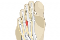 How Did I Get Morton’s Neuroma?